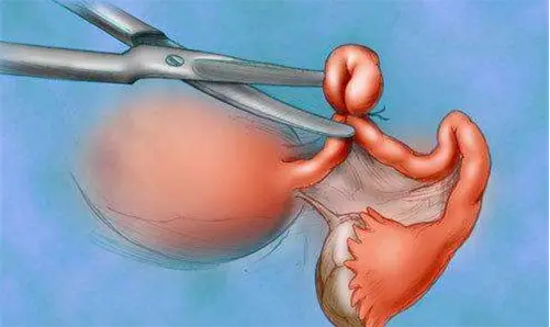 宿迁借卵试管-一些医生建议妇女在做试管婴儿前先把输卵管钳住，而在钳住输卵管的情况下做试管婴儿还有这些好处